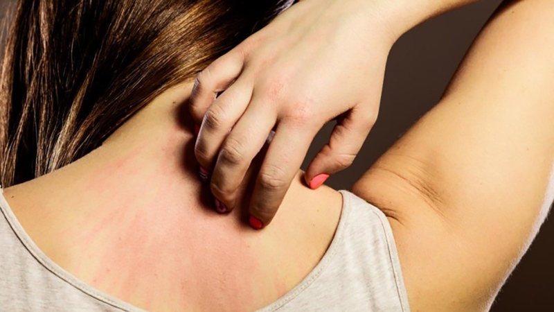 Cách xử trí và phòng ngừa trong trường hợp bị dị ứng cá biển 2