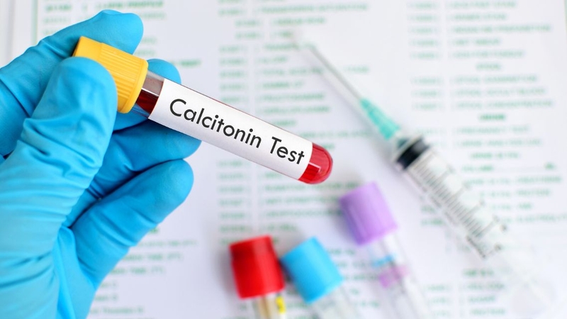 Nồng độ calcitonin tăng có thể gợi ý ung thư tuyến giáp thể tủy