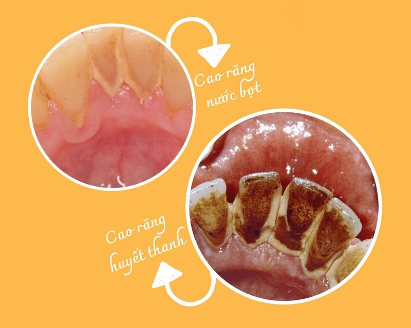 Cao răng huyết thanh là gì? Cách phòng ngừa cao răng như thế nào 1