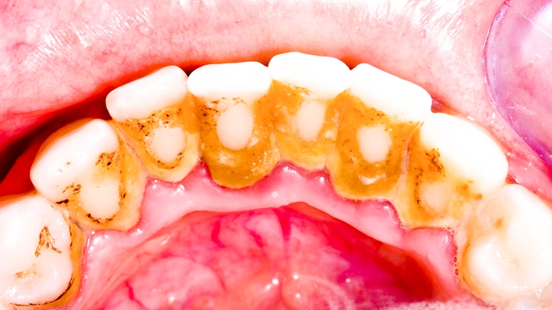 Cao răng huyết thanh là gì? Cách phòng ngừa cao răng như thế nào 2