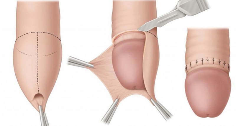 Cắt bao quy đầu bao lâu thì lành? Những lưu ý sau cắt bao quy đầu 2