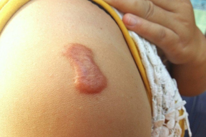 Cắt sẹo lồi giá bao nhiêu? Phương pháp cắt sẹo lồi nào tốt nhất? 2