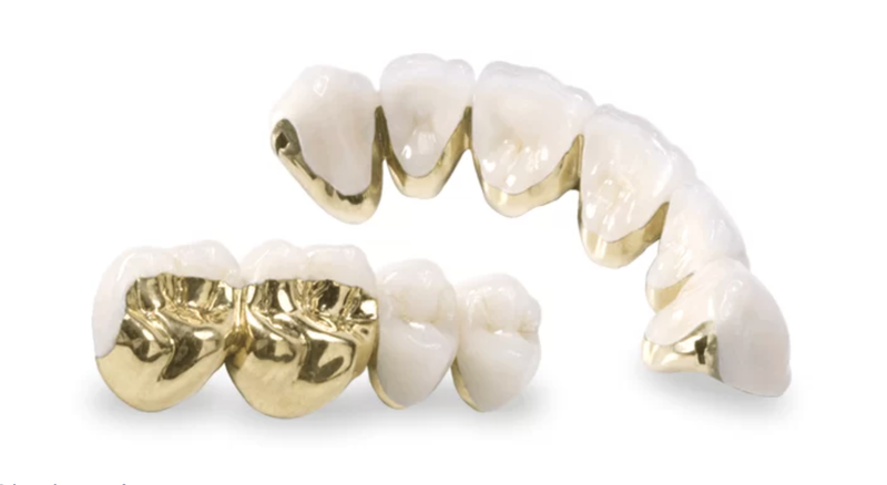 cau-rang-su-mot-giai-phap-nha-khoa-hieu-qua 2