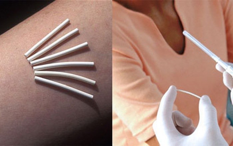 Cấy que tránh thai cần kiêng những gì 2