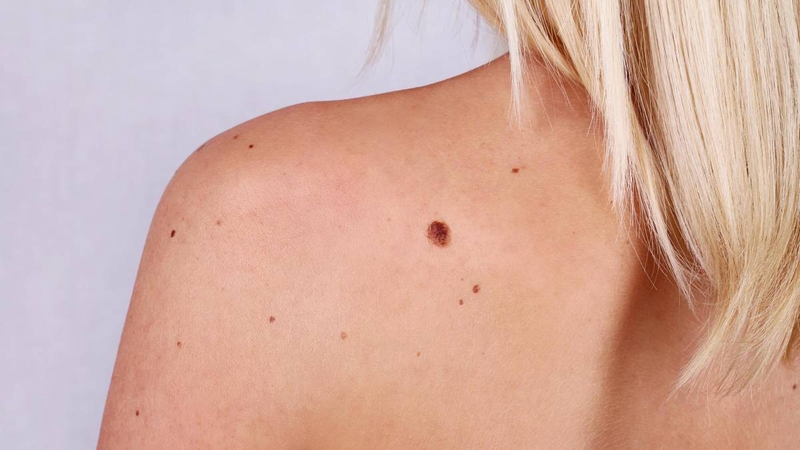 Cháy nắng và ung thư da có mối liên hệ với nhau không 2