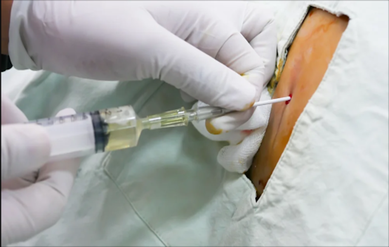 Chọc dịch màng bụng là thủ thuật gì 2.png