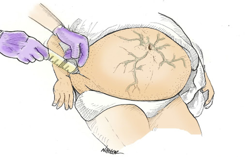 Chọc dịch màng bụng là thủ thuật gì 3.png