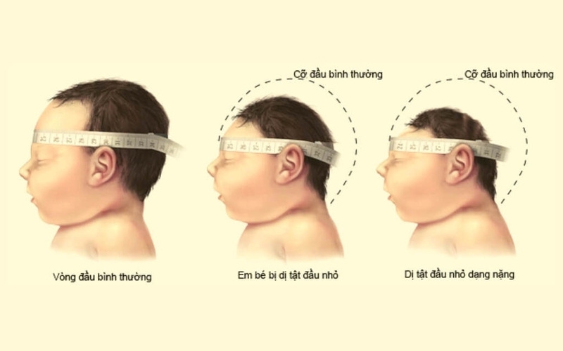 Chu vi vòng đầu của trẻ là gì? Cách đo chu vi vòng đầu chính xác mà cha mẹ nên biết 1