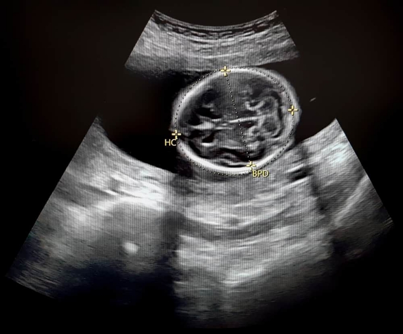 Chu vi vòng đầu thai nhi là gì? Chỉ số quan trọng tới sức khỏe mẹ và bé 2