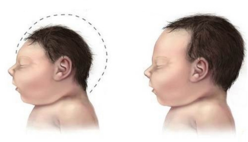 Chu vi vòng đầu thai nhi là gì? Chỉ số quan trọng tới sức khỏe mẹ và bé 4