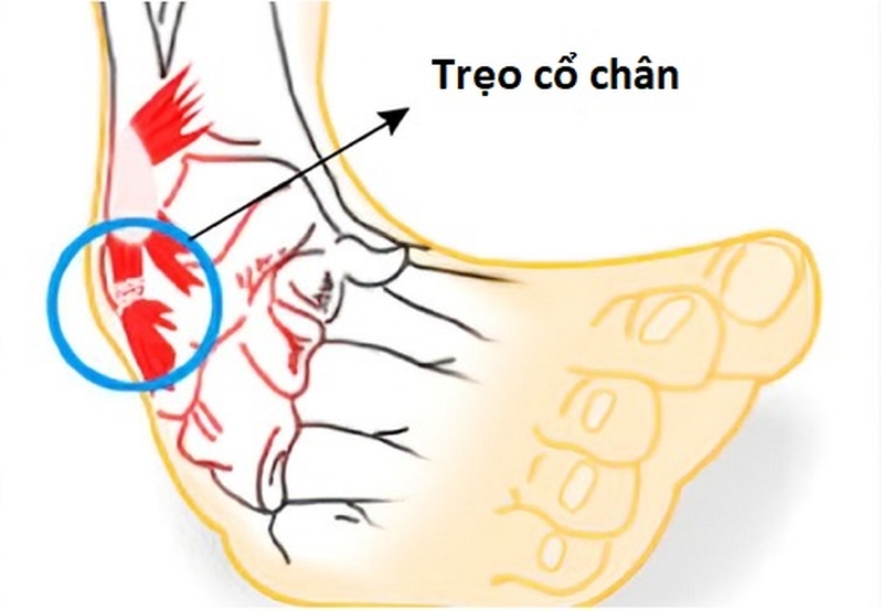 Mách bạn những cách chữa trị đá bóng bị trẹo cổ chân tại nhà 2