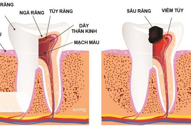 Chữa tủy răng bao lâu sẽ lành? Trường hợp nào thì cần chữa tủy răng? 2