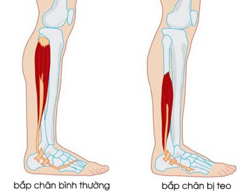 Chuột rút khi đá bóng thì phải làm sao để xử trí 1