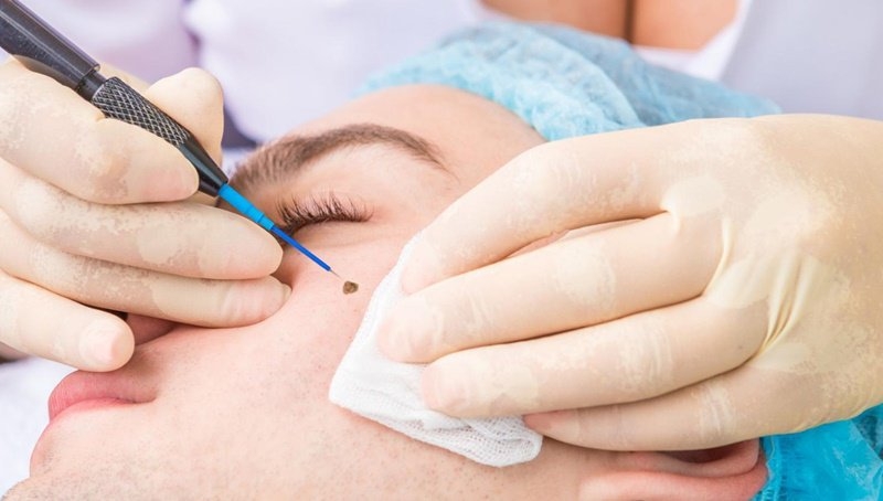 Chuyên gia giải đáp tẩy nốt ruồi có đau không 3.jpg