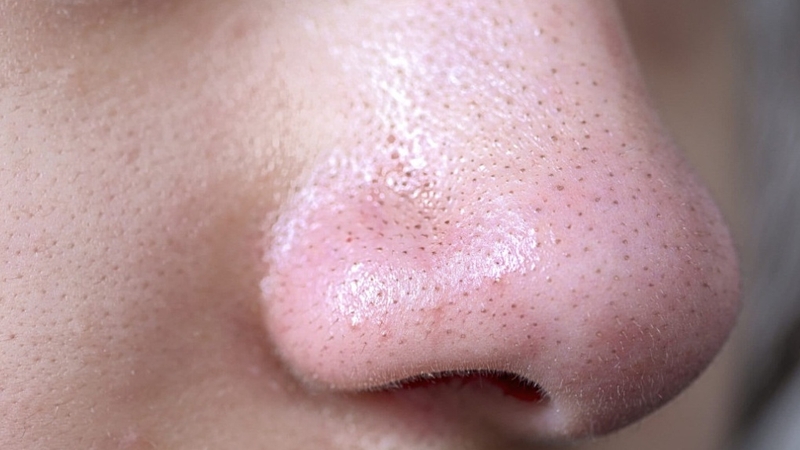 Có nên lột mụn đầu đen không? Gợi ý mặt nạ từ thiên nhiên hiệu quả, an toàn 1