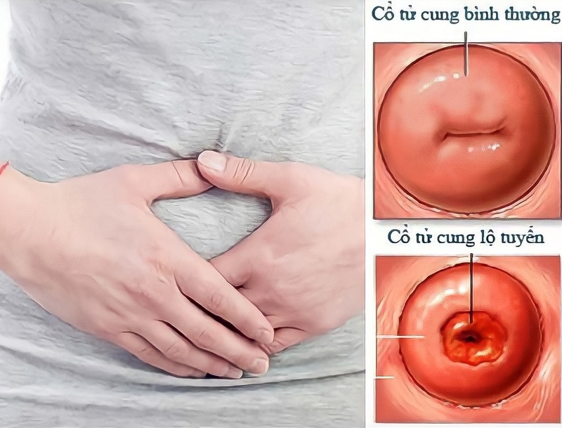 Cổ tử cung tái tạo là gì? Viêm cổ tử cung tái tạo có nguy hiểm không? 1