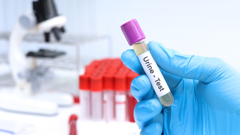 Những yếu tố ảnh hưởng đến kết quả xét nghiệm nước tiểu bạn cần biết 6
