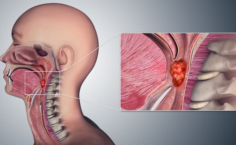 Cùng chuyên gia giải đáp thắc mắc: Ung thư vòm họng có di truyền không? 1