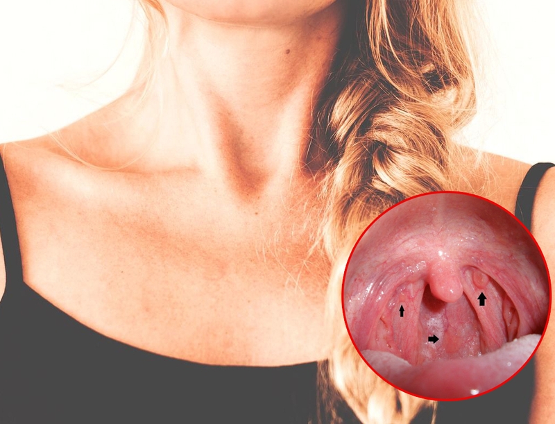 Cùng chuyên gia giải đáp thắc mắc: Ung thư vòm họng có di truyền không? 3