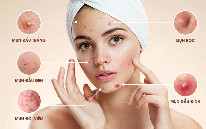 Mách bạn những cách trị mụn ở tuổi dậy thì đúng và hiệu quả 1