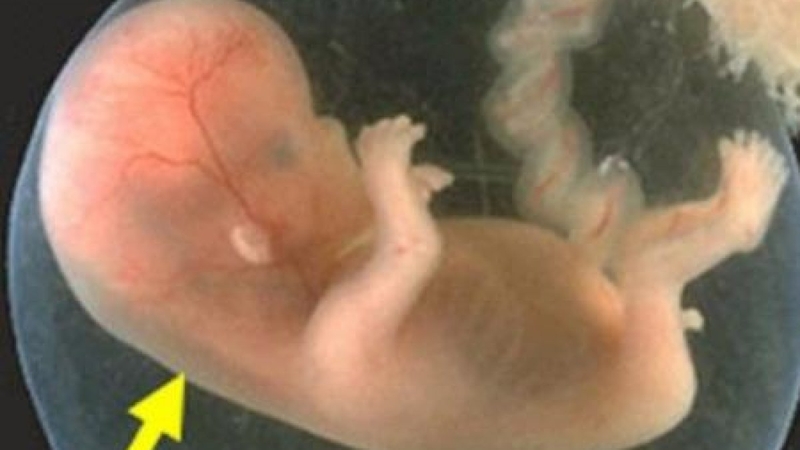 Độ mờ da gáy 1.7 mm có bình thường không? 1