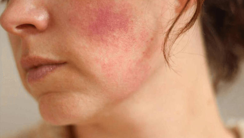 Da nhiễm Corticoid là gì? Soi da nhiễm Corticoid bằng máy có chuẩn xác không 2