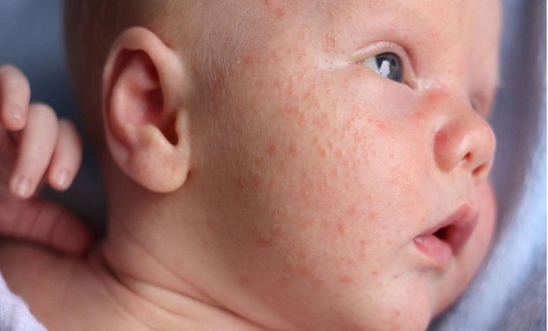 Da trẻ sơ sinh không đều màu có sao không? Nguyên nhân khiến da trẻ sơ sinh không đều màu 1