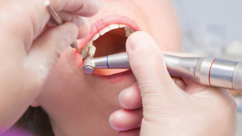 Đánh bóng răng có trắng không? Quy trình đánh bóng răng thế nào 2