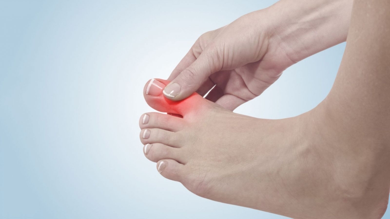 Đau đốt ngón chân cái có phải bệnh Gout không 1