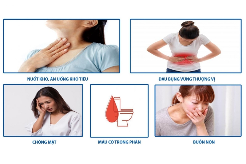 Dấu hiệu của U mô đệm đường tiêu hóa