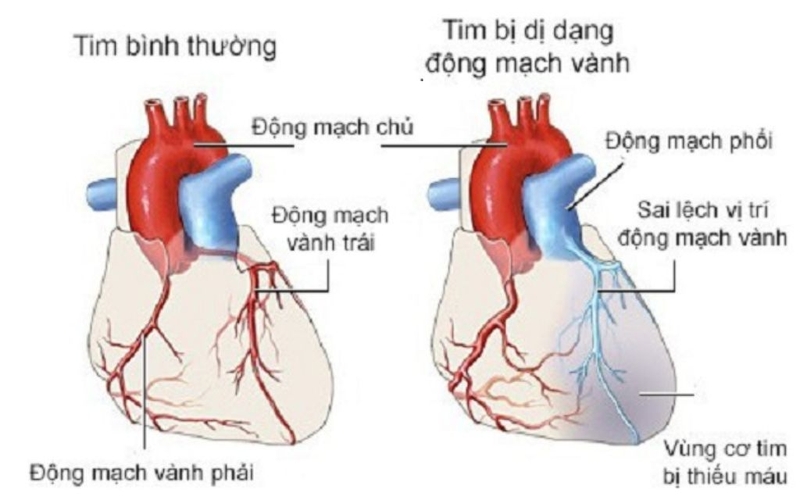 Dị dạng mạch vành là gì? Nguyên nhân, triệu chứng và phương pháp điều trị 1