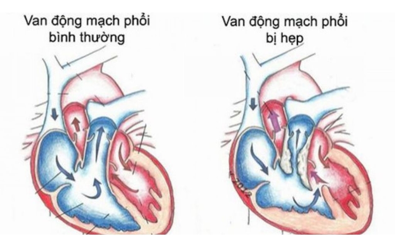 Dị dạng mạch vành là gì? Nguyên nhân, triệu chứng và phương pháp điều trị 2
