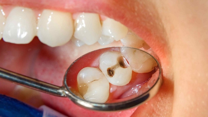Sâu răng có thể dần mở rộng ra, phá huỷ cấu trúc răng
