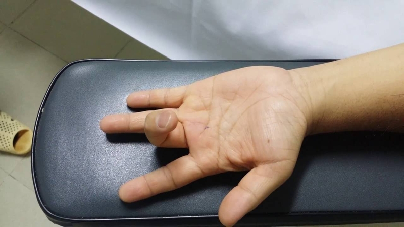 Điều trị và phòng ngừa bệnh ngón tay cò súng 1