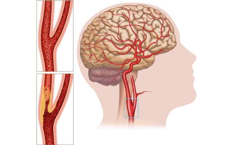 Động mạch cổ nằm ở vị trí nào? Chức năng và vai trò trong lâm sàng 3