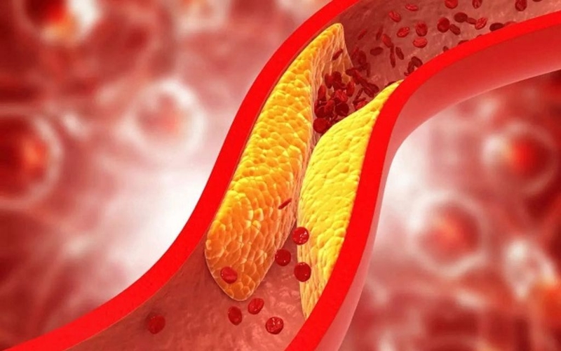 Đột quỵ do tắc mạch từ tim nguy hiểm không? Nguyên nhân, triệu chứng và chẩn đoán 2