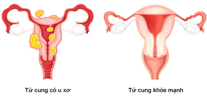 Dùng nấm lim xanh chữa u xơ tử cung, nên hay không? Những điều chị em không nên bỏ lỡ 2