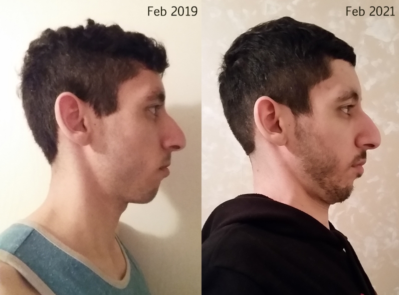 Hướng dẫn các bài tập mewing cho mặt lệch vô cùng là đơn giản 2