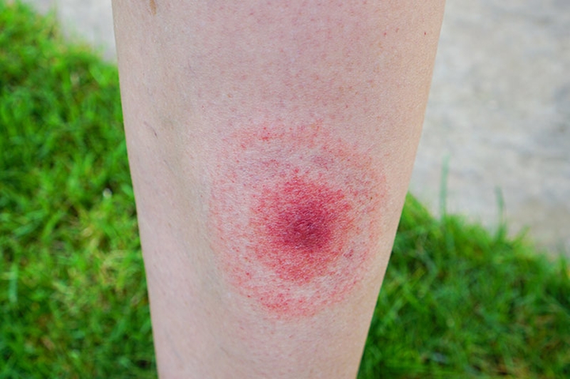 Đau khớp ngón tay tuổi trẻ - Chứng bệnh nguy hiểm không thể bỏ qua! 2