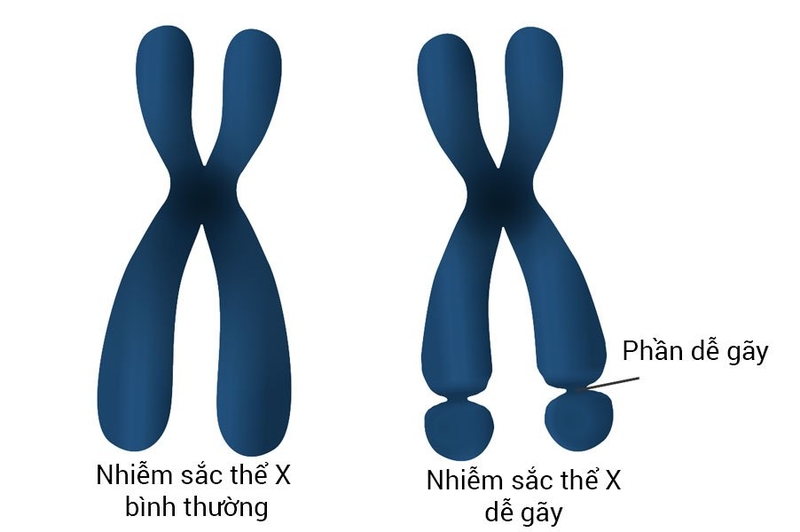 Hội chứng Fragile X có nhiễm sắc thể giới tính X dễ đứt gãy