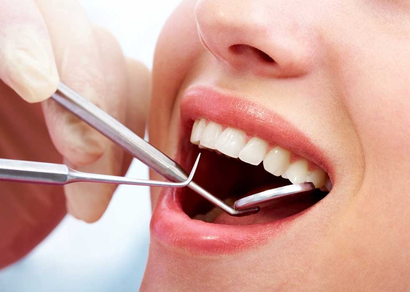 Bao lâu lấy cao răng 1 lần là tốt nhất là câu hỏi không của riêng ai