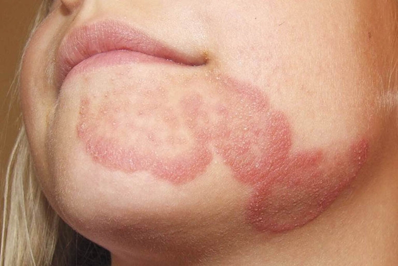 Giải đáp: Bệnh hắc lào có lây nhiễm không 1