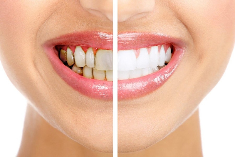 Bị sâu răng có tẩy trắng được không phụ thuộc vào nhiều yếu tố