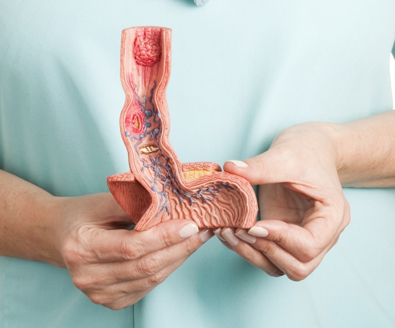 Giải đáp thắc mắc cùng chuyên gia: Ung thư thực quản có di truyền không? 1