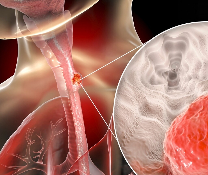 Giải đáp thắc mắc cùng chuyên gia: Ung thư thực quản có di truyền không? 3