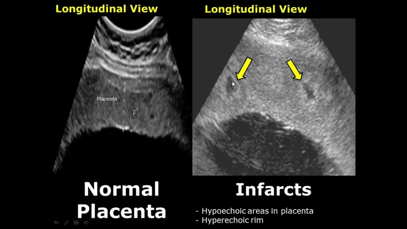 Giải đáp thắc mắc: Hồ huyết bánh nhau có ảnh hưởng đến thai nhi không? 2