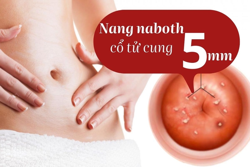 Giải đáp thắc mắc: Nang naboth là gì? Đốt nang naboth kiêng quan hệ bao lâu?