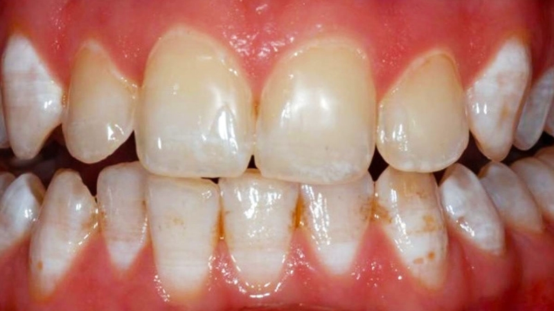 Giải đáp thắc mắc "Răng nhiễm Fluor là gì 1