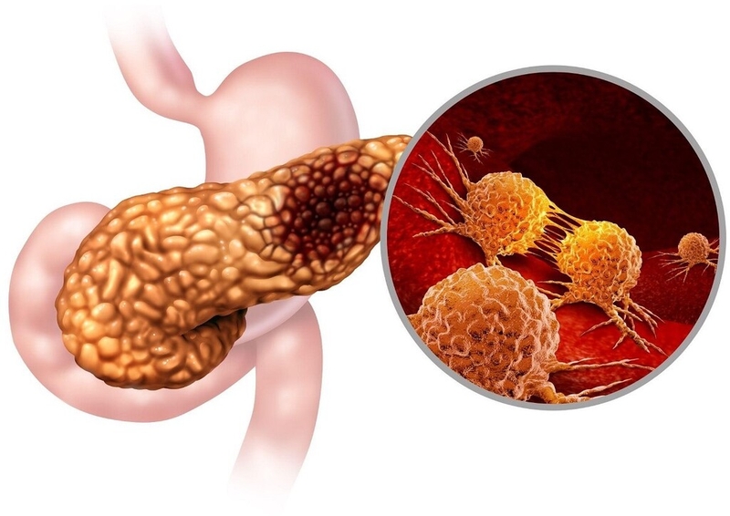 Giải đáp thắc mắc: Viêm tụy cấp là gì? Viêm tụy cấp có chữa khỏi được không? 2