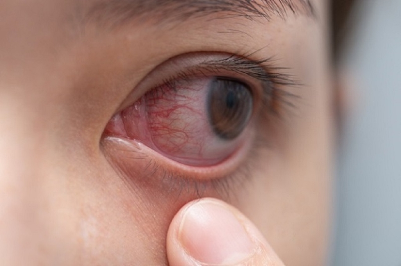 Giải pháp cho vấn đề dụi mắt bị sưng tròng trắng 1